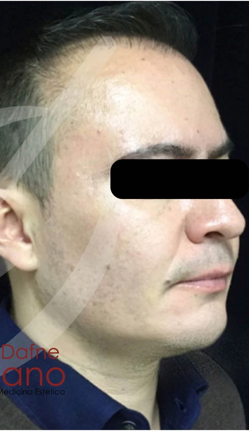 Armonización facial después — paciente 1 de Dra. Dafne Arellano, Puebla