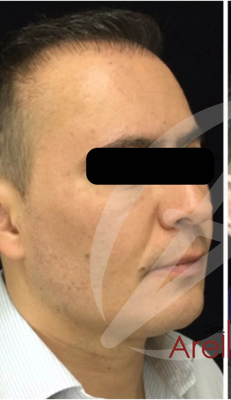 Armonización facial antes — paciente 1 de Dra. Dafne Arellano, Puebla