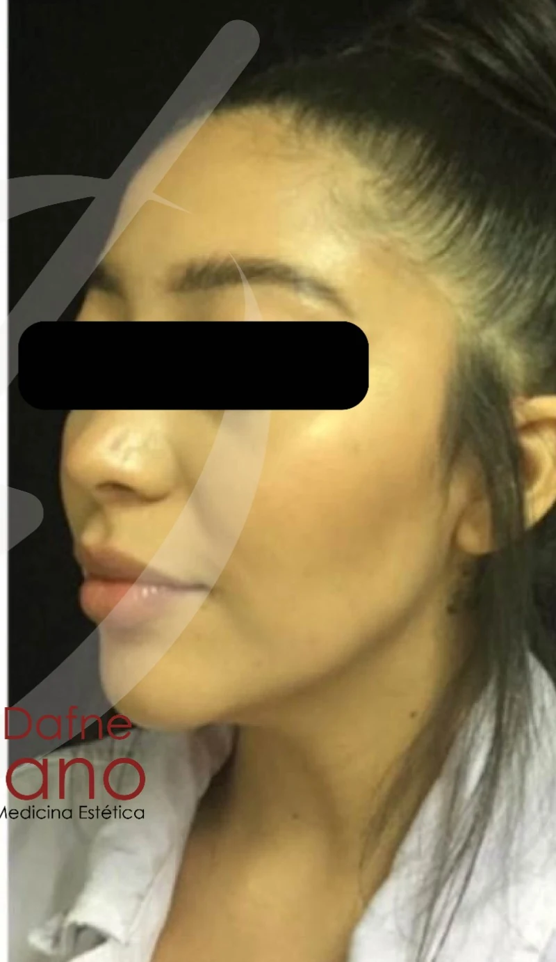 Armonización facial después — paciente 2 de Dra. Dafne Arellano, Puebla