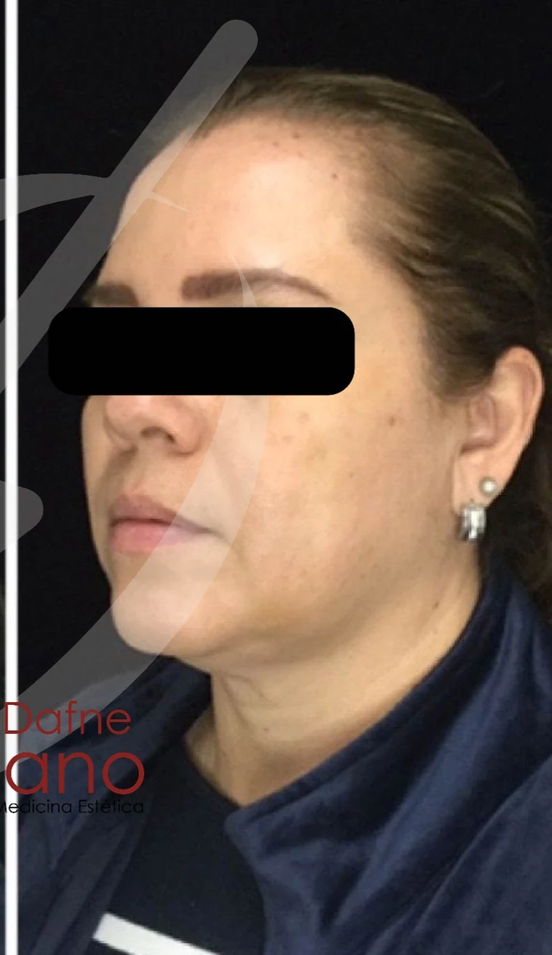 Armonización facial después — paciente 4 de Dra. Dafne Arellano, Puebla