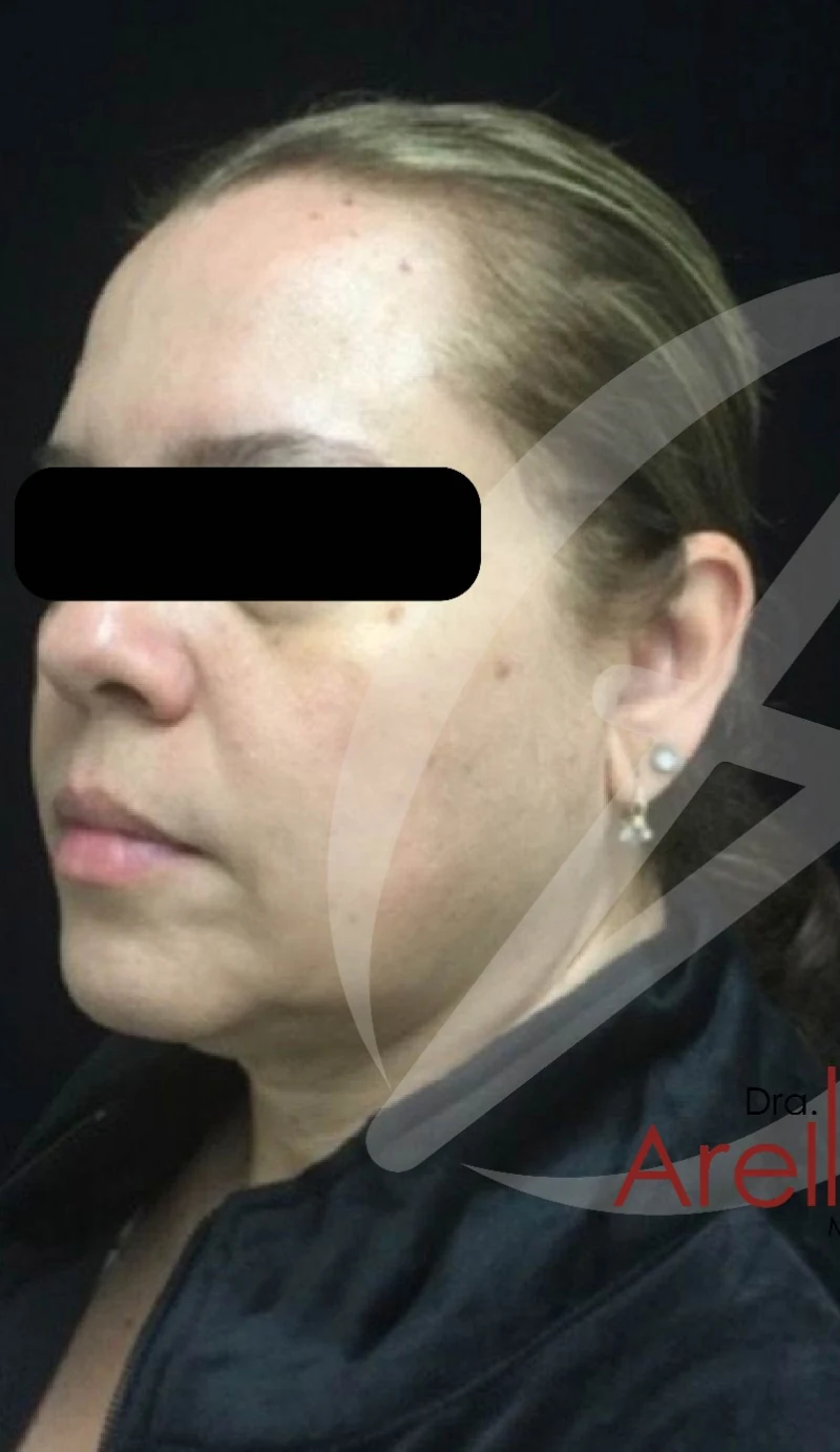 Armonización facial antes — paciente 4 de Dra. Dafne Arellano, Puebla