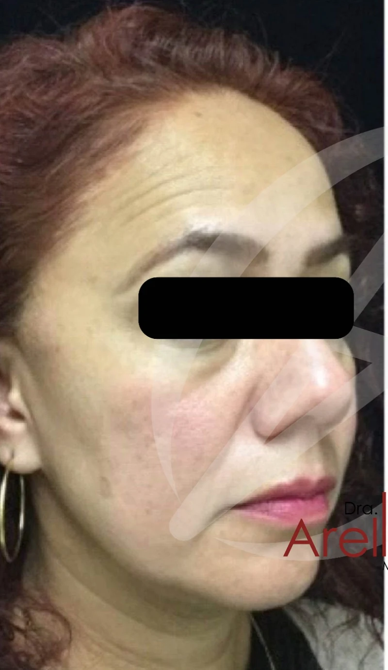 Armonización facial antes — paciente 5 de Dra. Dafne Arellano, Puebla