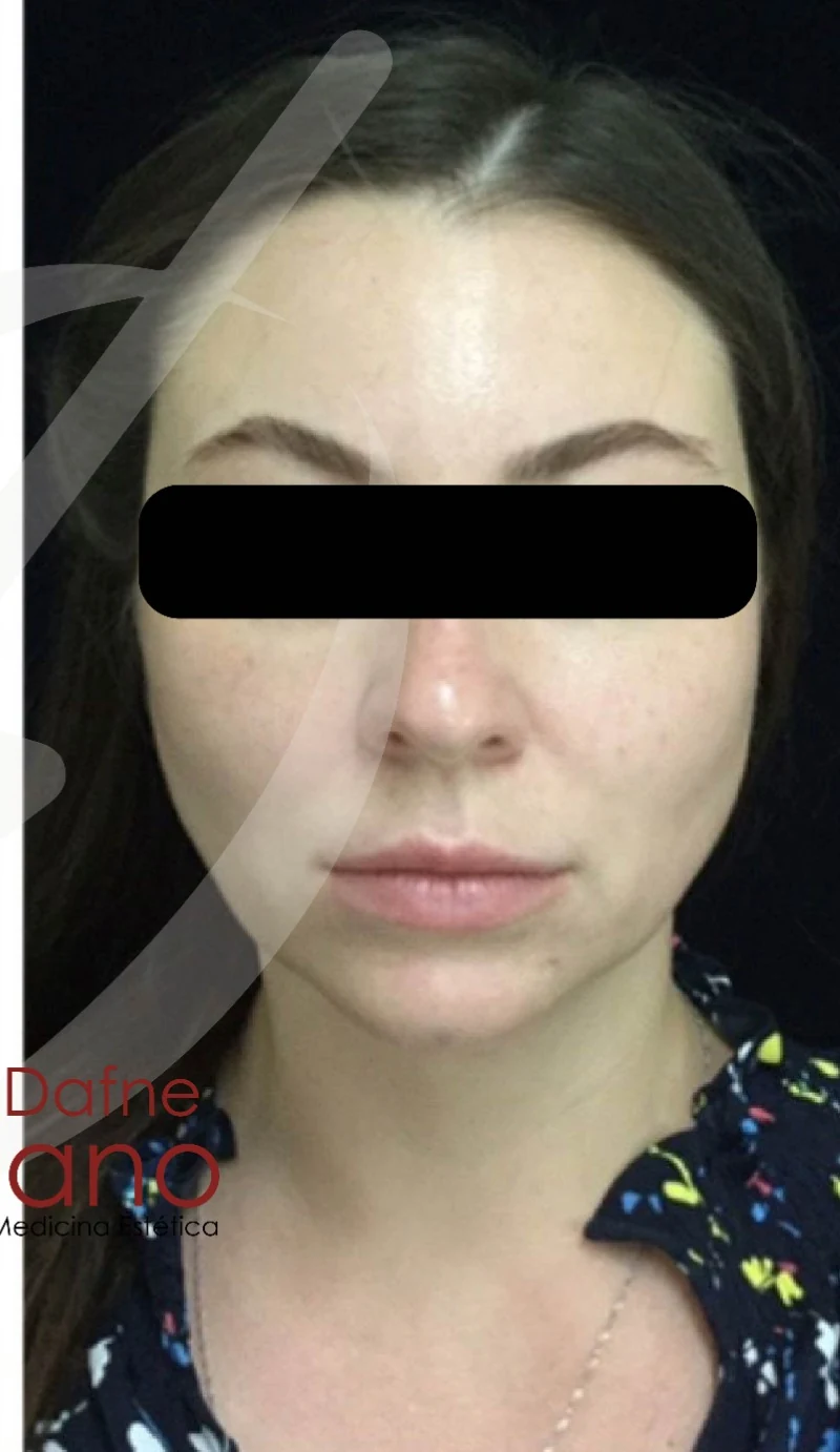 Armonización facial después — paciente 6 de Dra. Dafne Arellano, Puebla