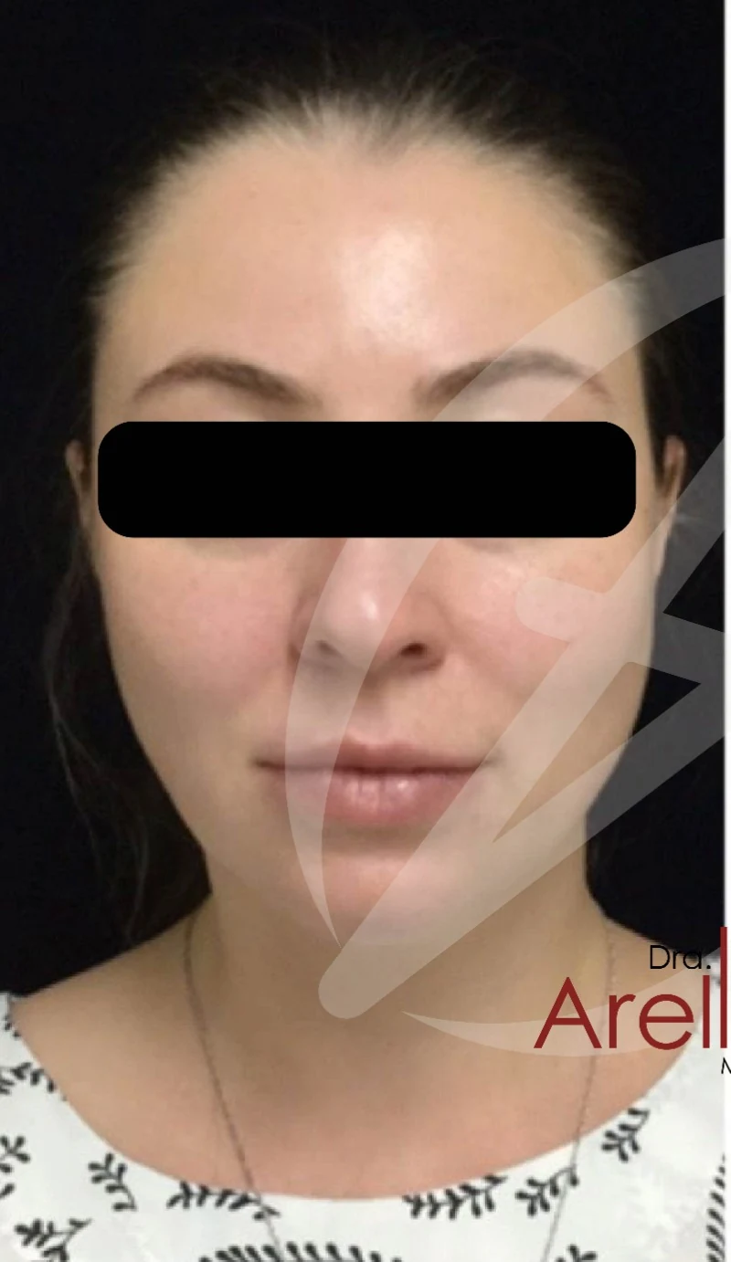 Armonización facial antes — paciente 6 de Dra. Dafne Arellano, Puebla