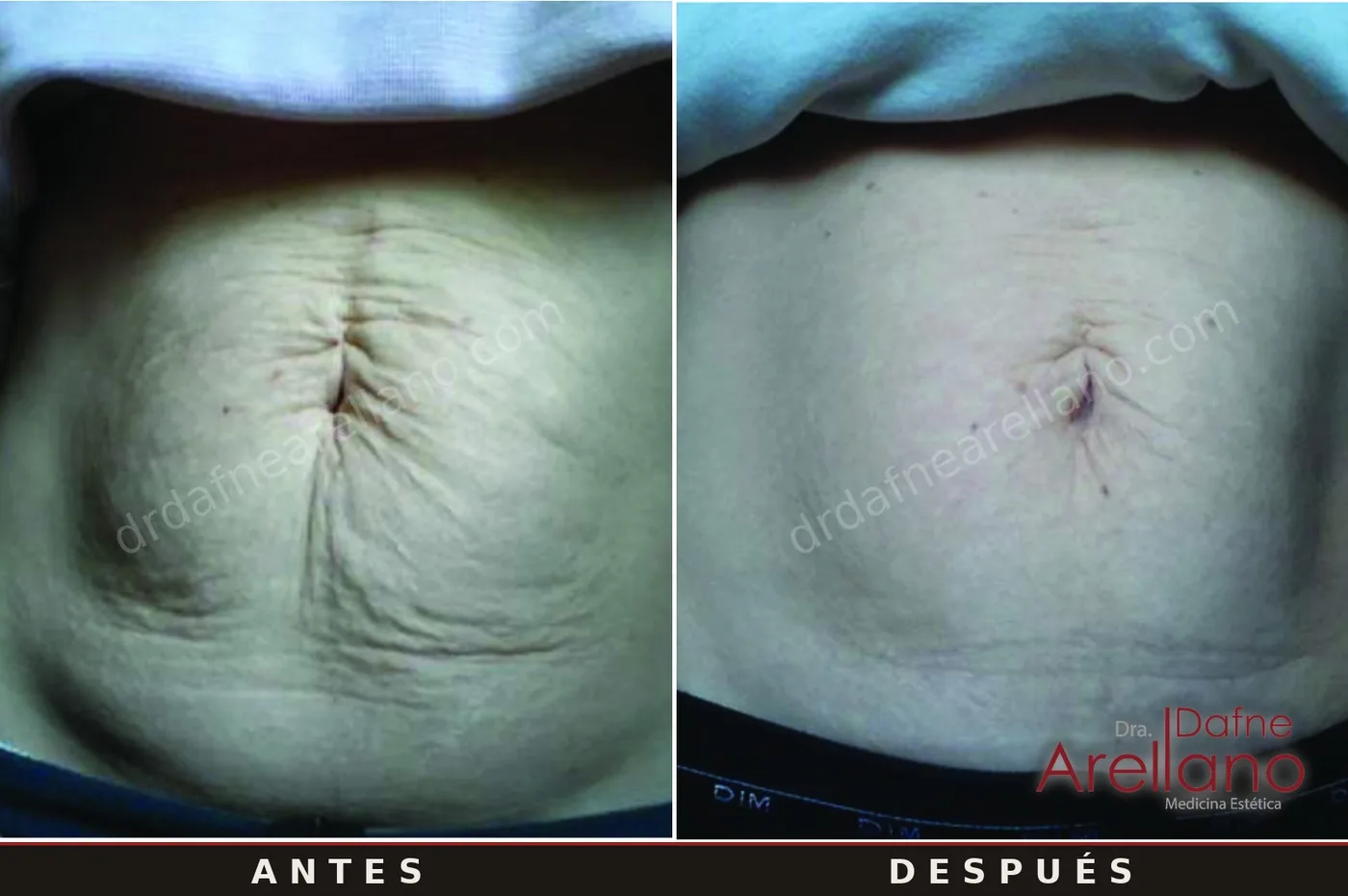 Evidencia clínica EndyMed — flacidez de abdomen antes y después, resultados del fabricante