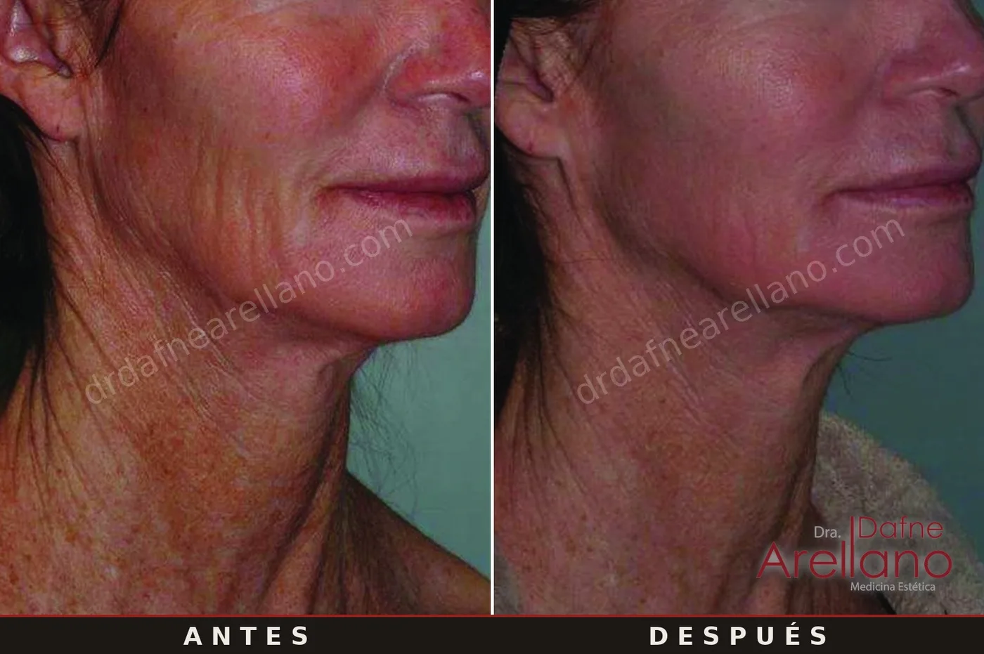 Evidencia clínica EndyMed — flacidez de jawline y cuello antes y después, resultados del fabricante