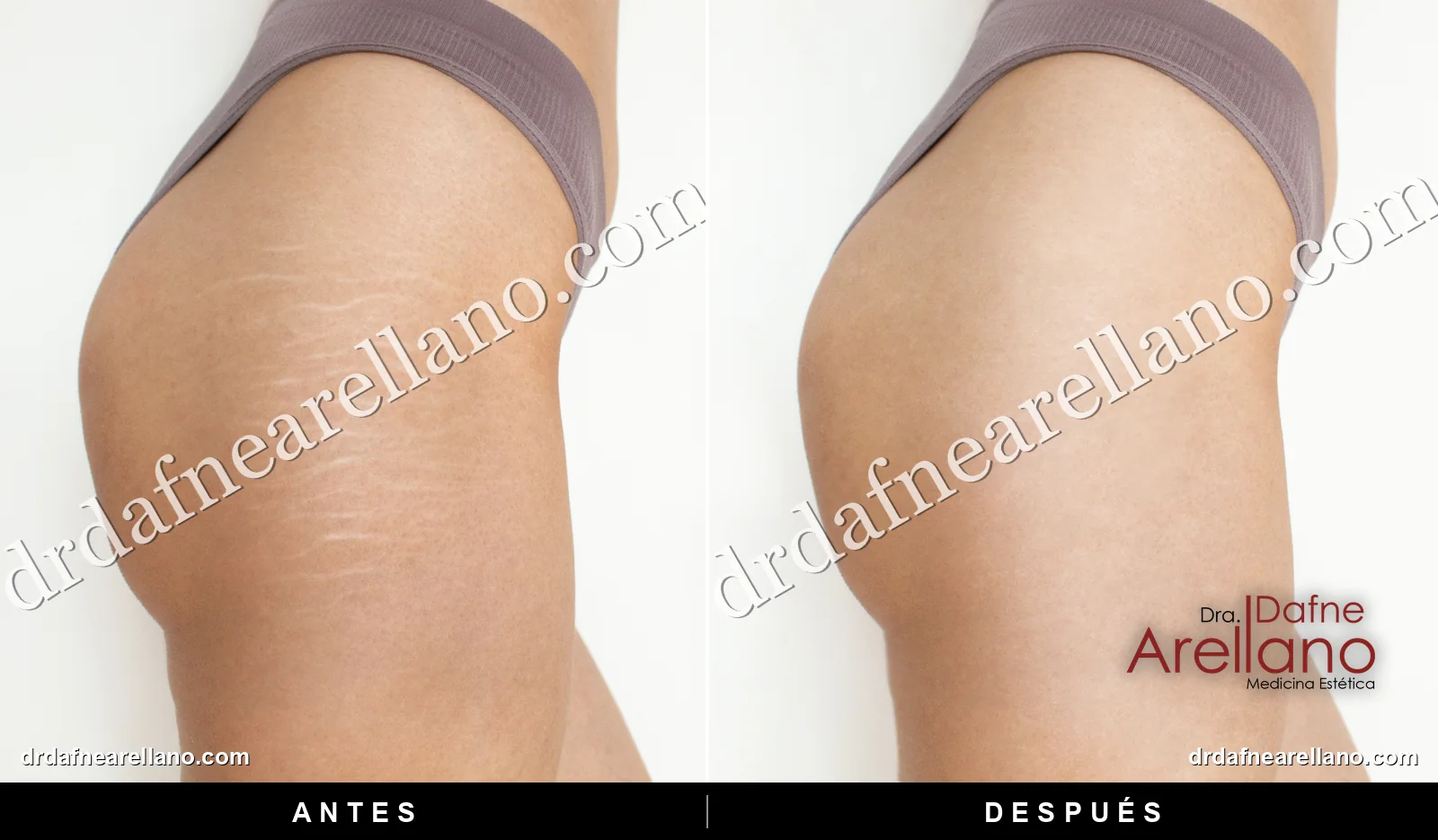 Referencia visual de calidad de piel en glúteo y cara lateral del muslo: comparación lado a lado de piel con estrías frente a piel de aspecto más uniforme.