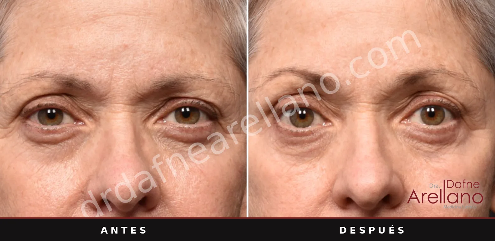 Antes y después de Sofwave: Cejas y mirada, a las 12 semanas de una sesión.