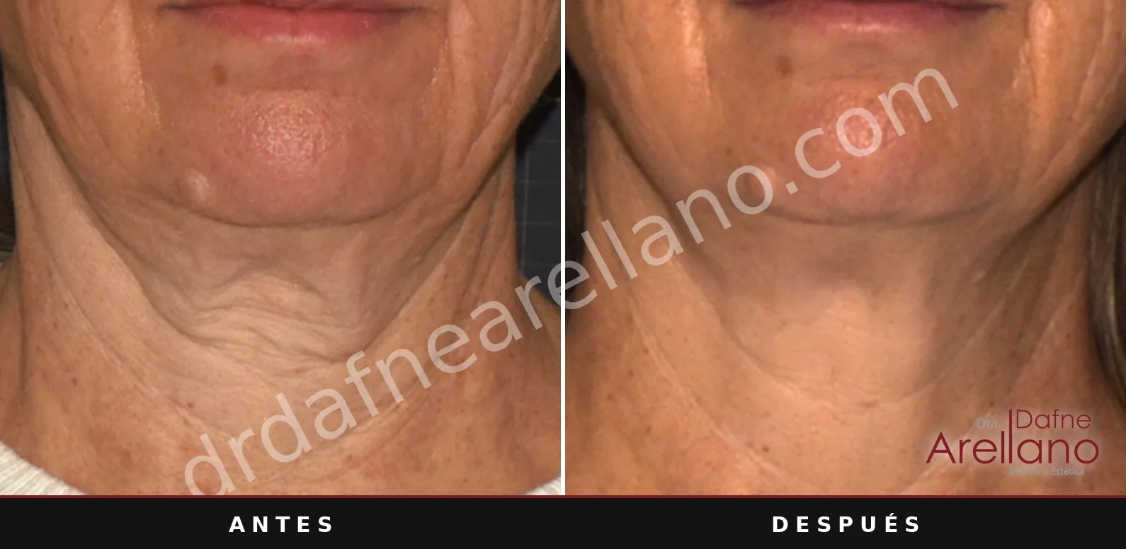 Antes y después de Sofwave: Cuello, a las 12 semanas de una sesión.