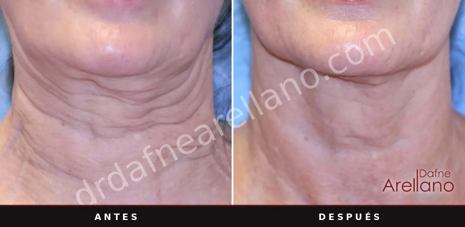 Antes y después de Sofwave: Cuello, a los 10 meses de una sesión.