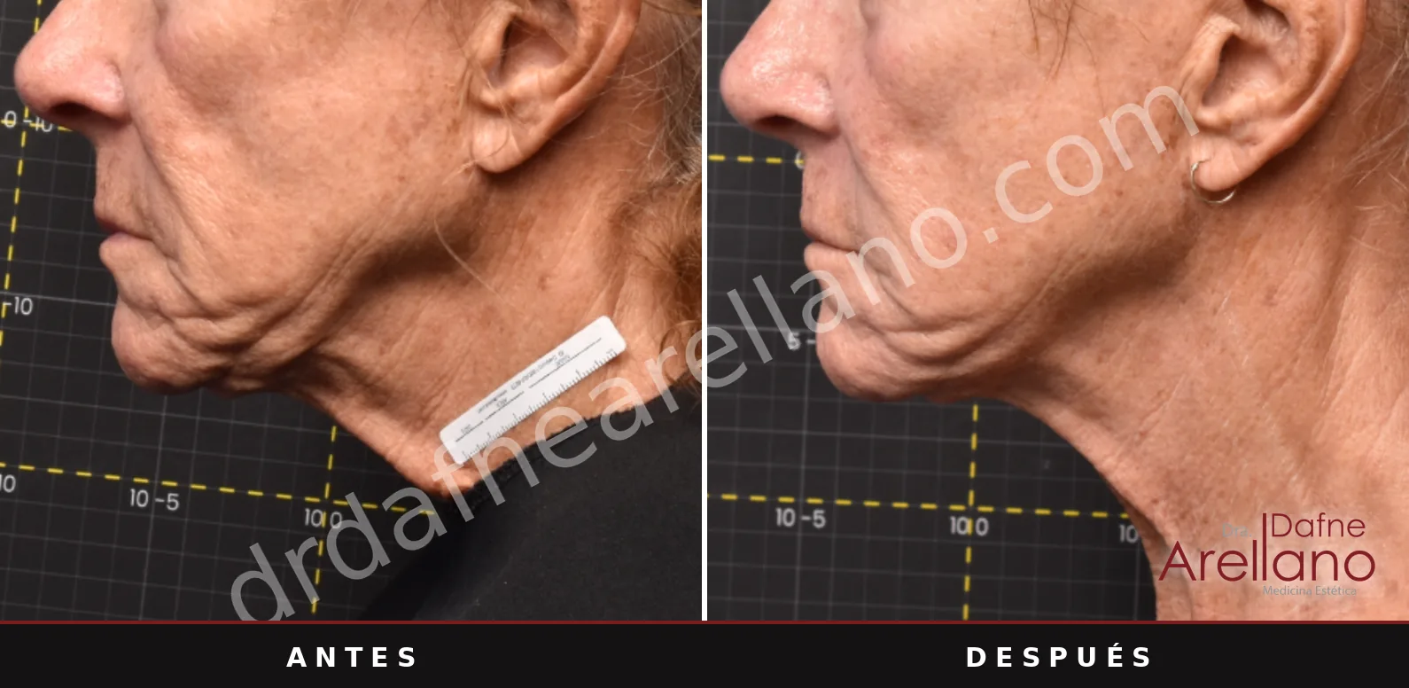 Antes y después de Sofwave: Papada y cuello, a las 9 semanas de una sesión.