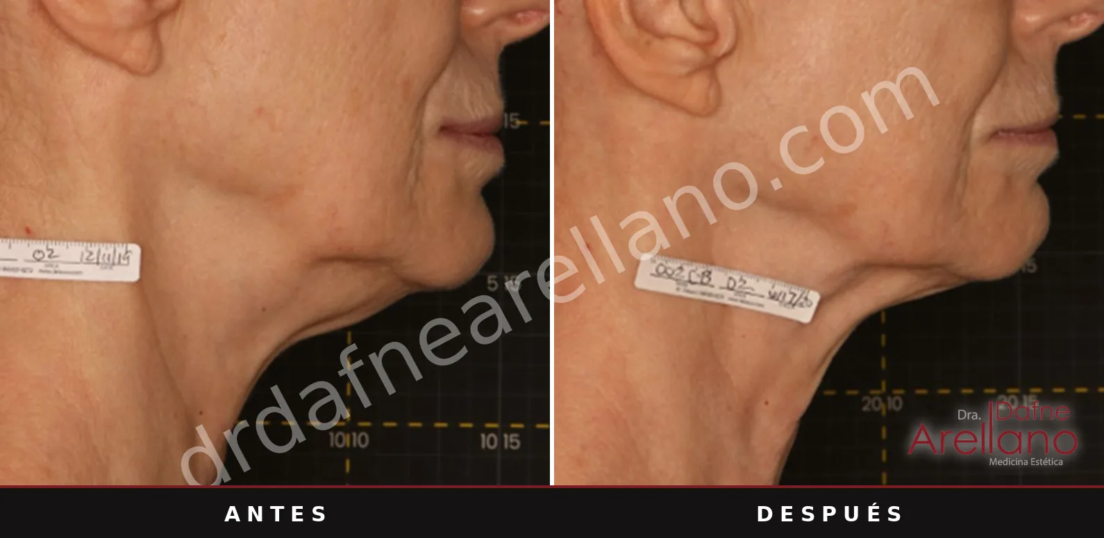 Antes y después de Sofwave: Papada, a los 6 meses de una sesión.