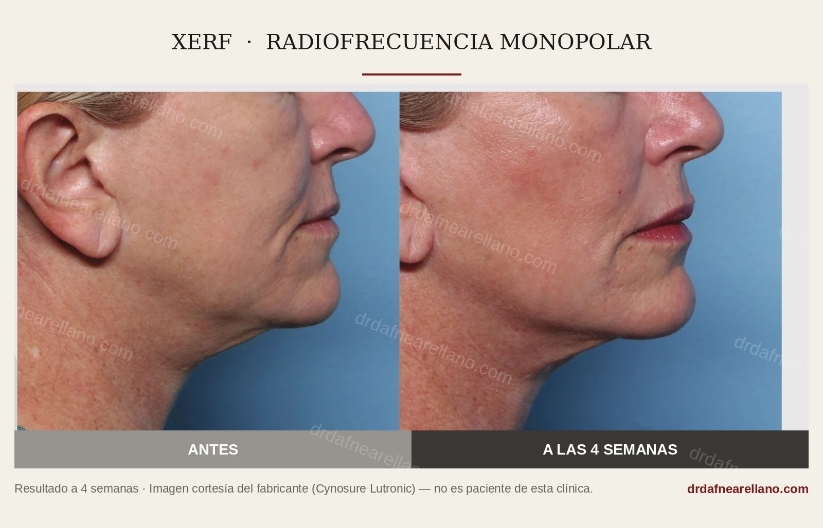 Antes y a las 4 semanas de tratamiento con XERF: mejoría del contorno mandibular y del cuello