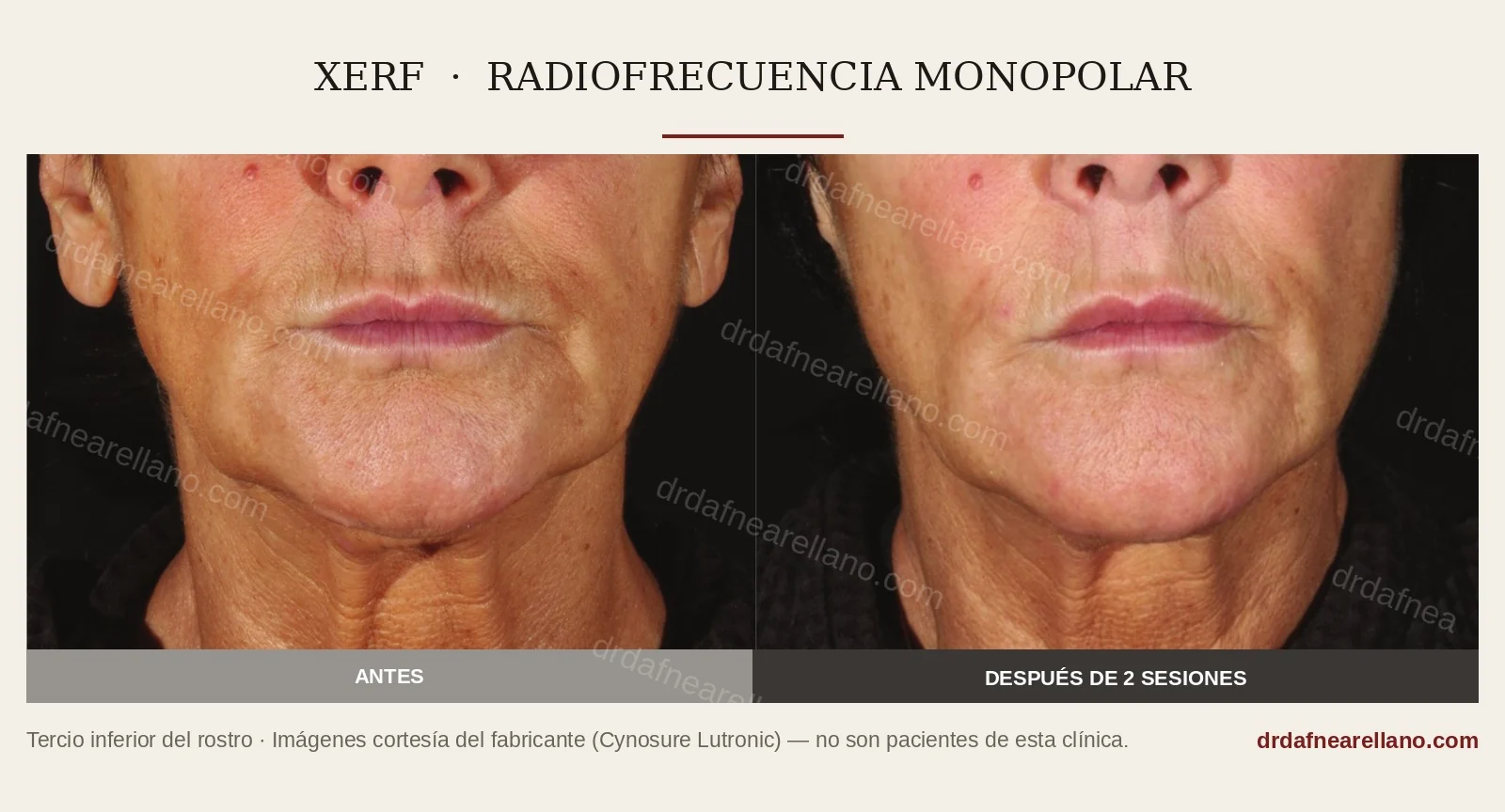 Antes y después de dos sesiones de XERF, vista frontal: tercio inferior del rostro y cuello