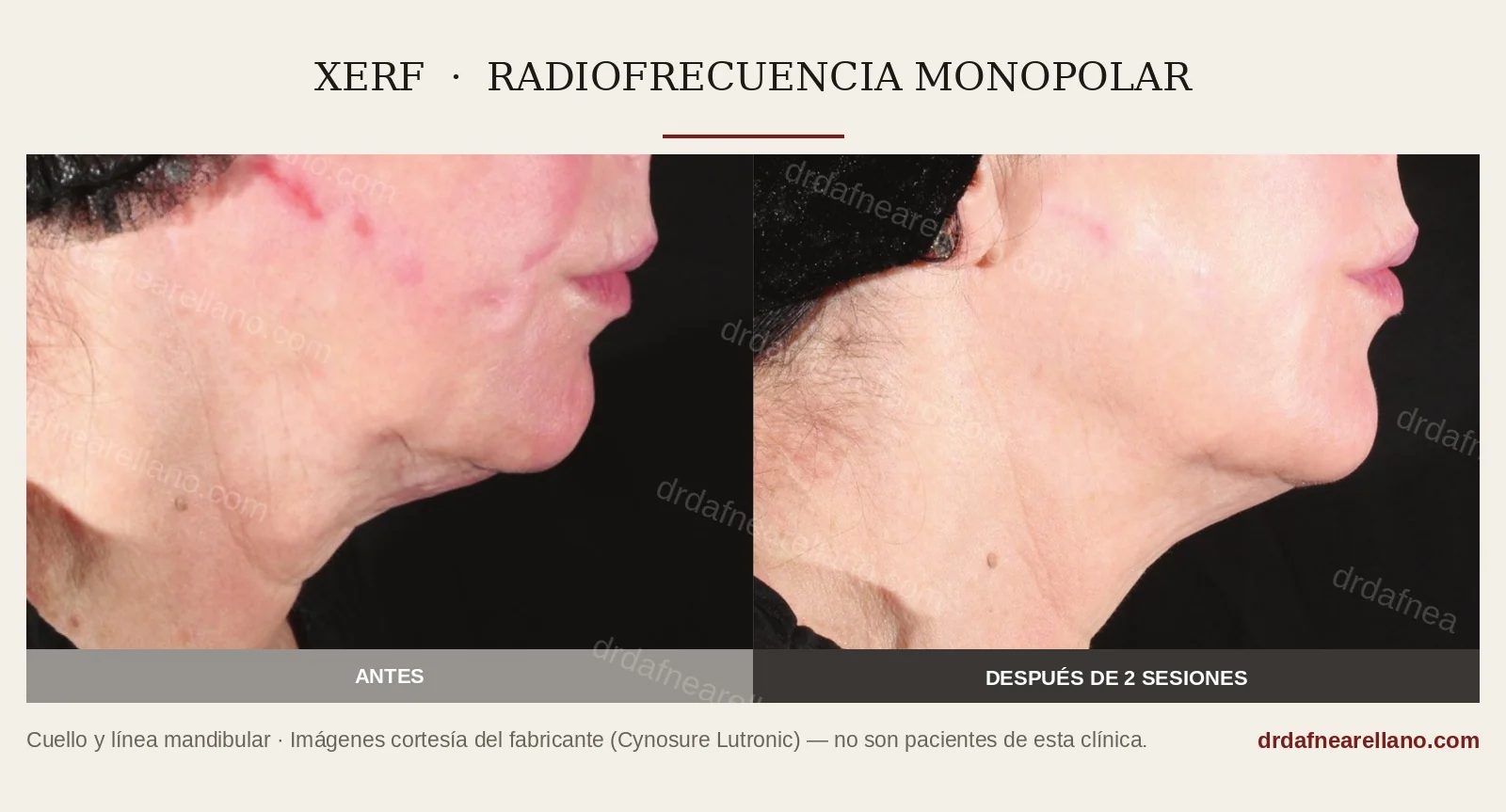 Antes y después de dos sesiones de XERF, vista de perfil: cuello y línea mandibular